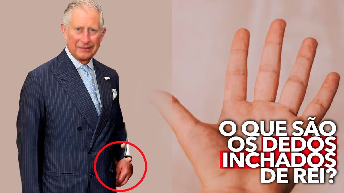 O que são os dedos inchados de Rei Charles III