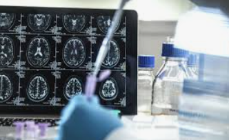 Anvisa aprova remédio para alzheimer com custo de 11 mil reais por mês no Brasil